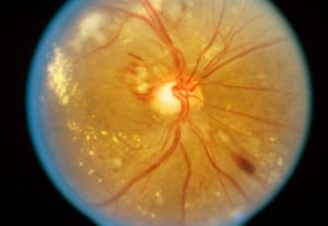 Гипертоническая ретинопатия (умеренная)