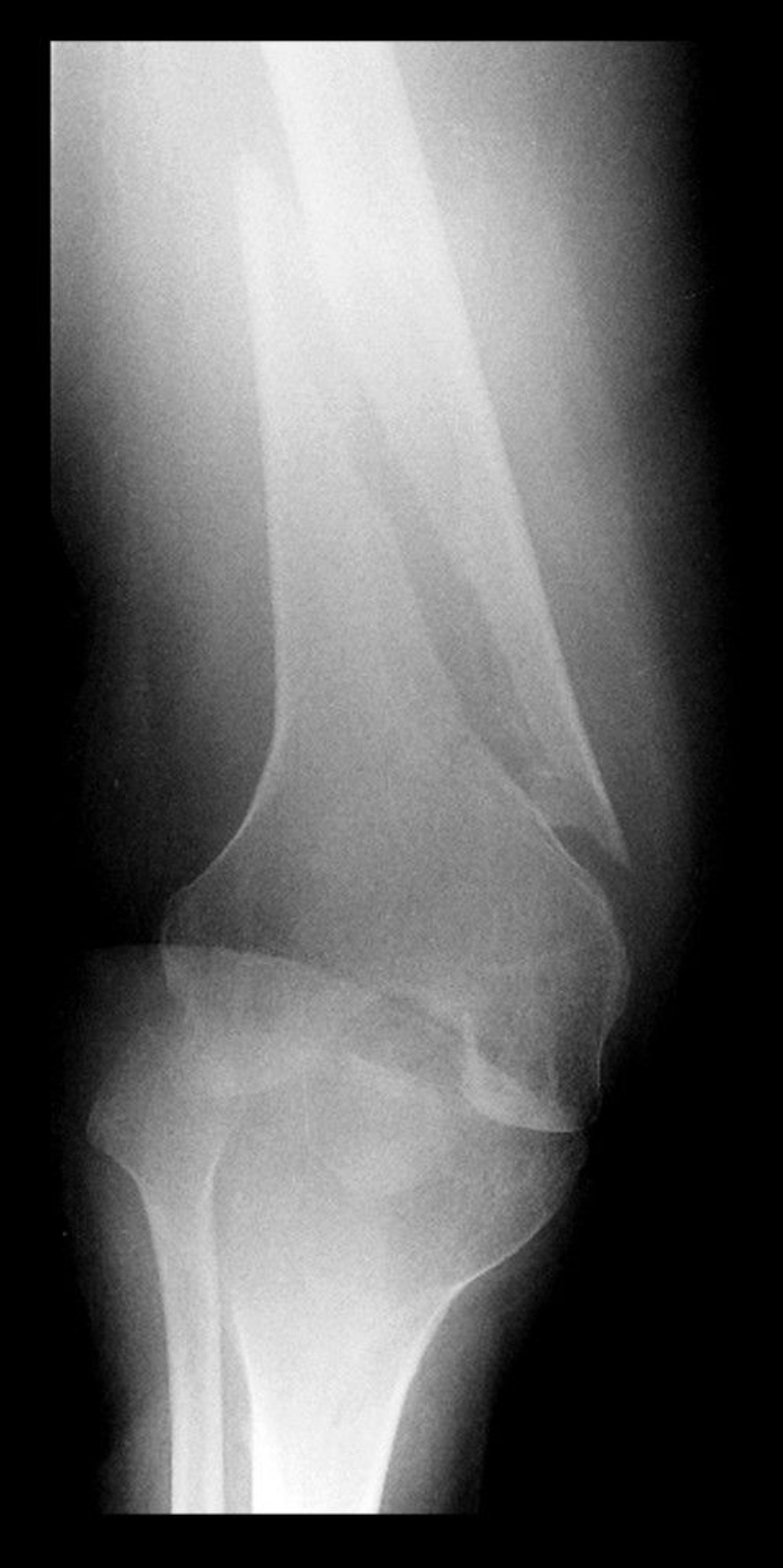 Spiral Fracture of the Distal Femur
