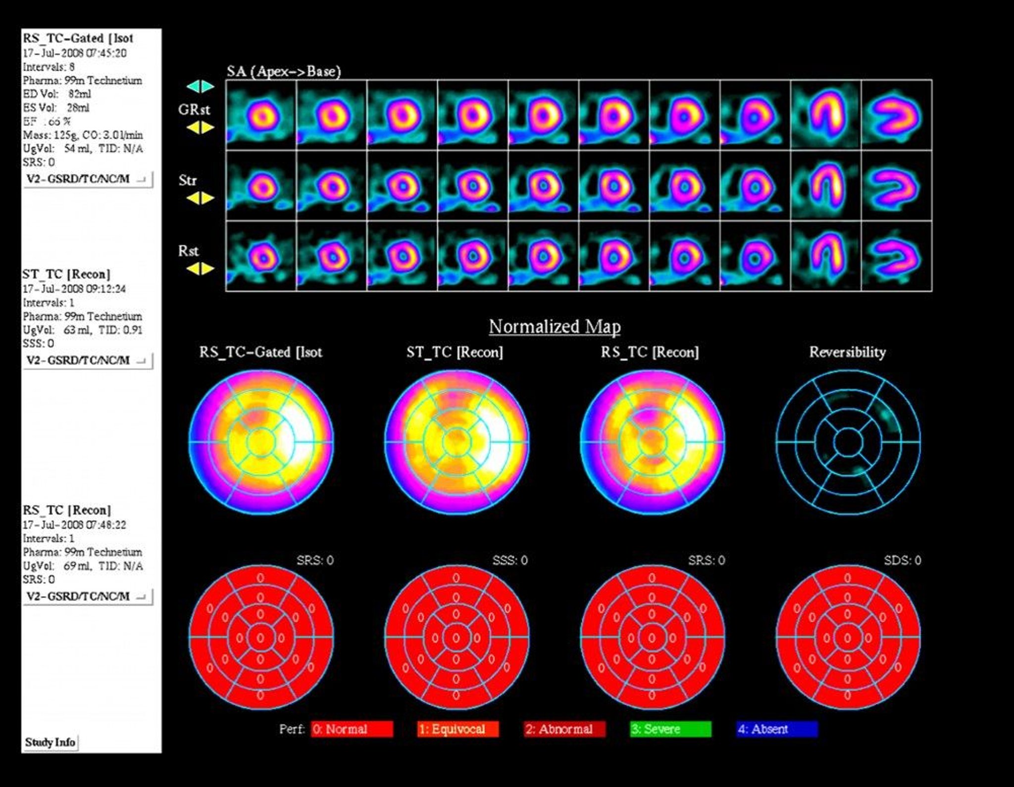 Nuclear Medicine Stress Test