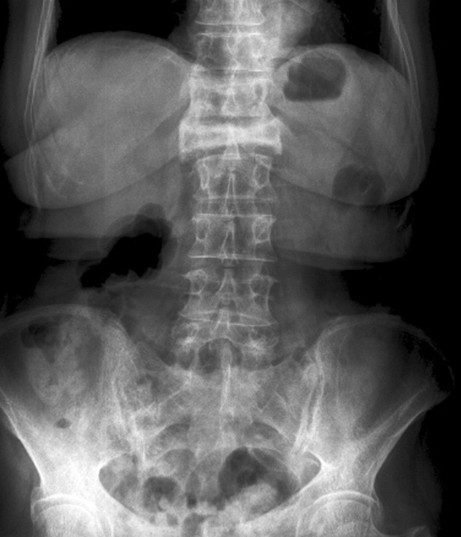 Anteroposterior View of a Severe Compression Fracture