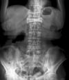 Incidence de face d'une fracture par compression (tassement) sévère