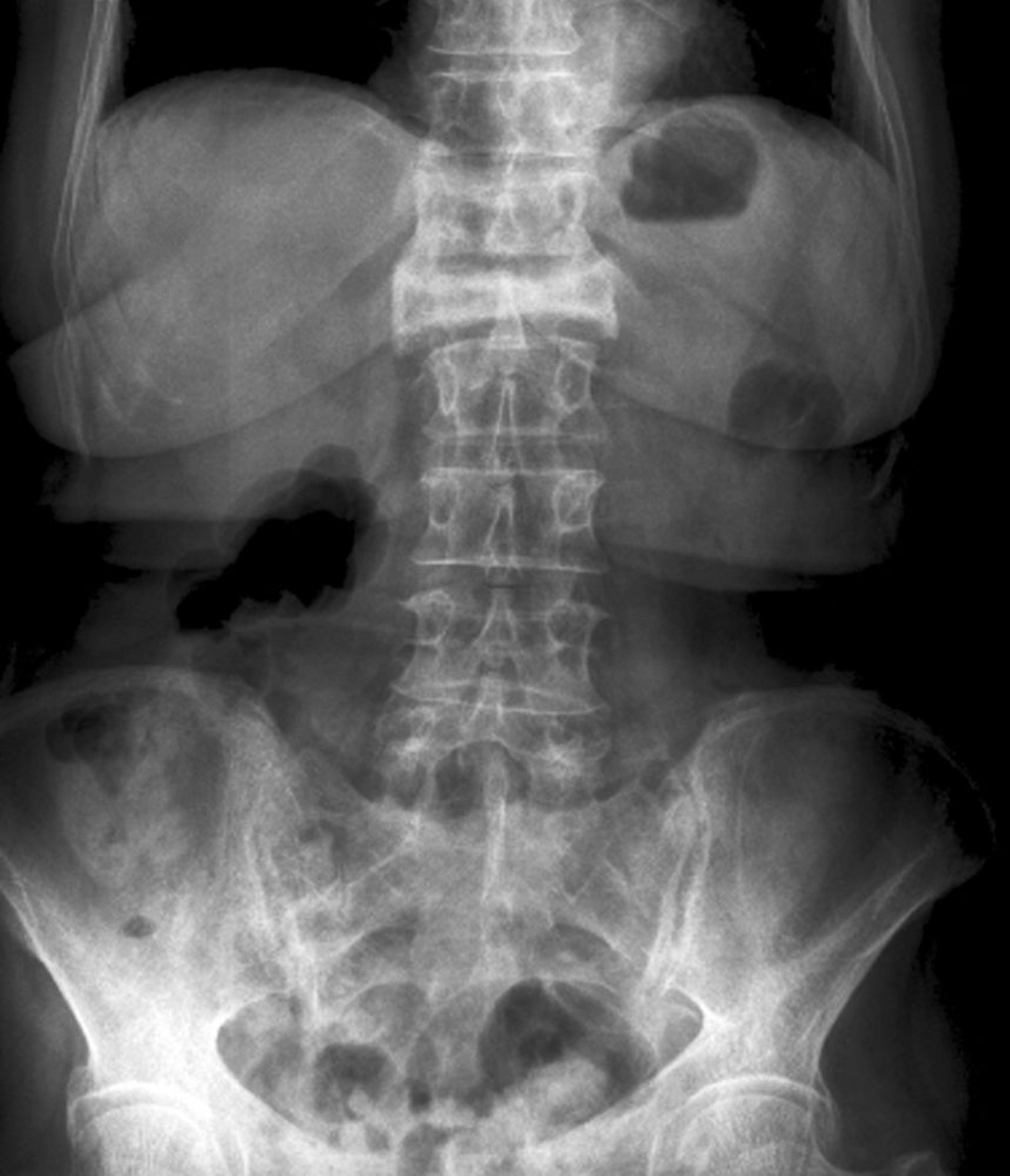 Incidence de face d'une fracture par compression (tassement) sévère