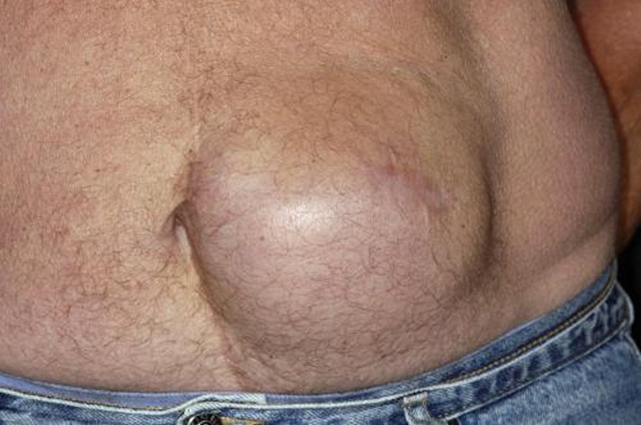 Hernia incisional abdominal