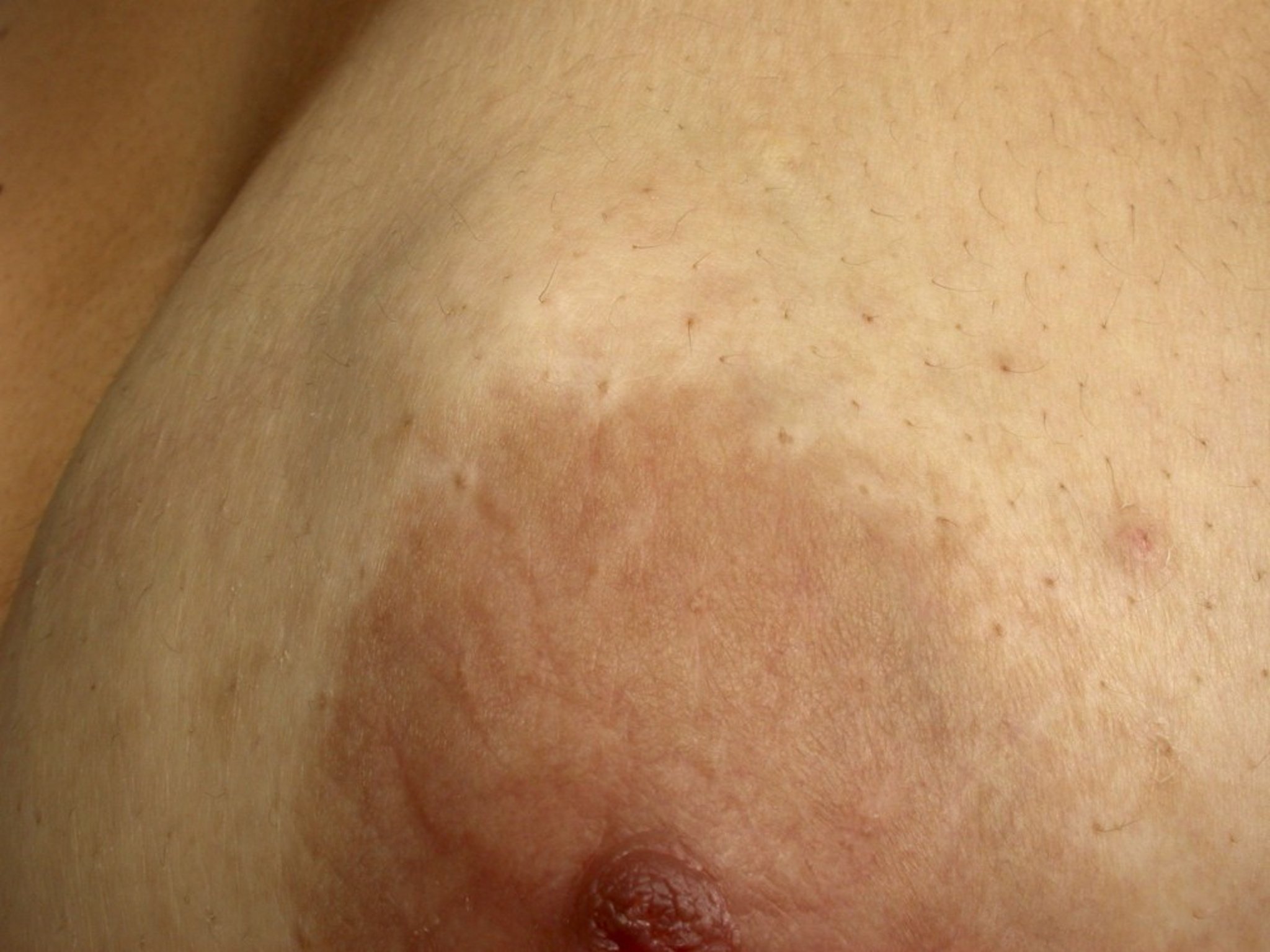 Breast Mass (Fibroadenoma)