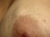 Breast Mass (Fibroadenoma)