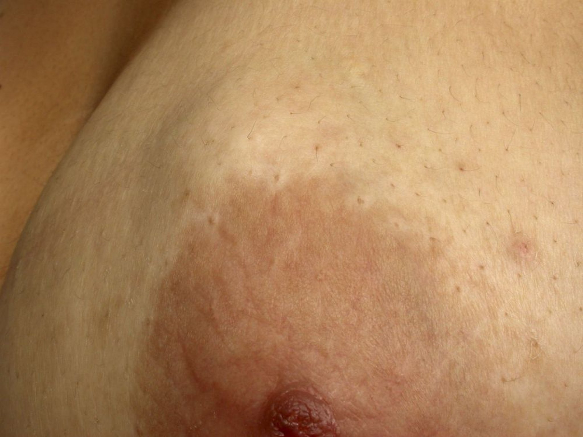乳房肿块（纤维腺瘤）
