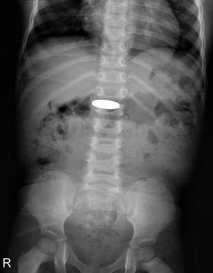 Инородное тело в желудочно-кишечном тракте (рентгеновский снимок)