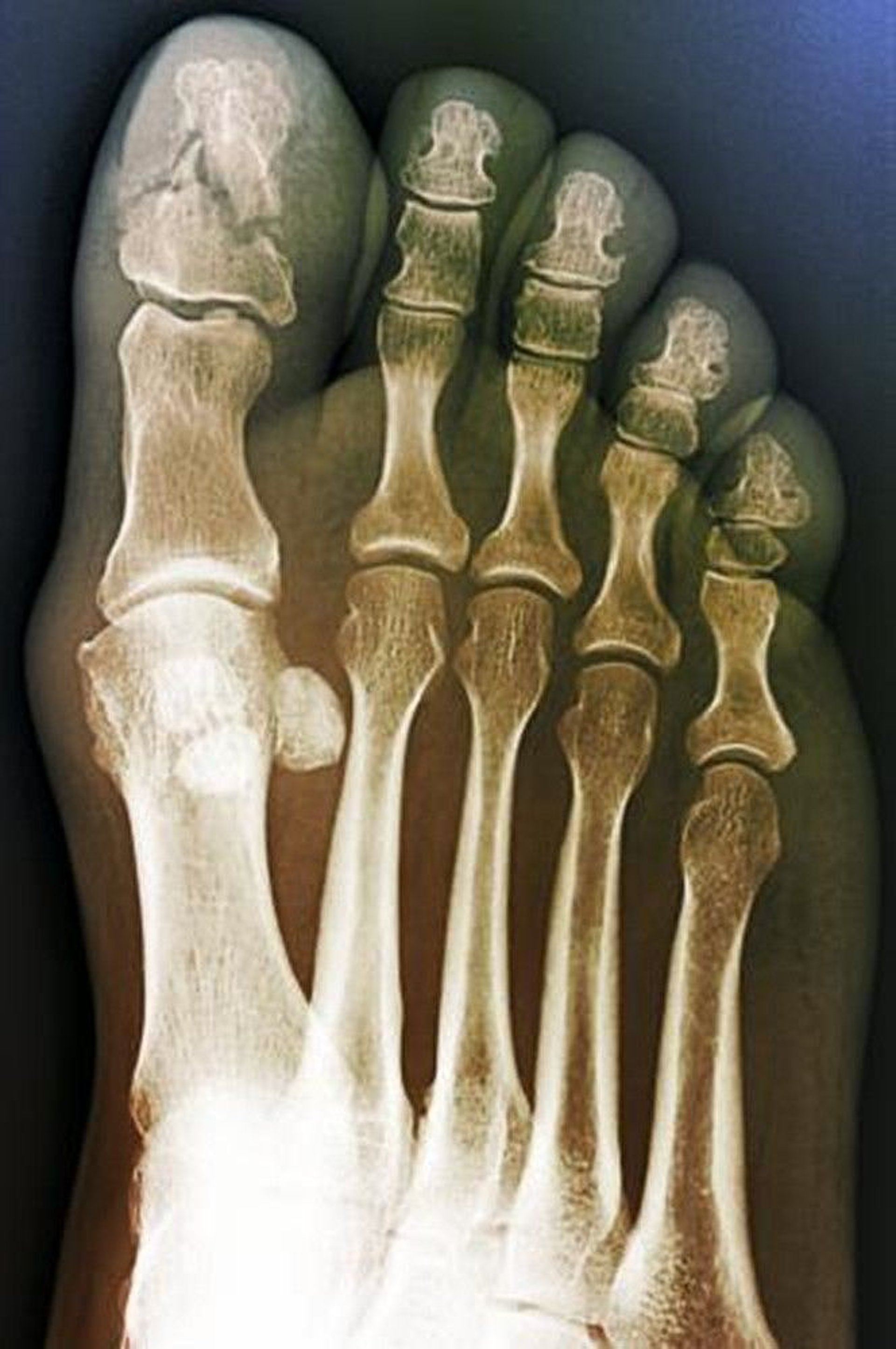 Comminuted Fracture of the Great Toe