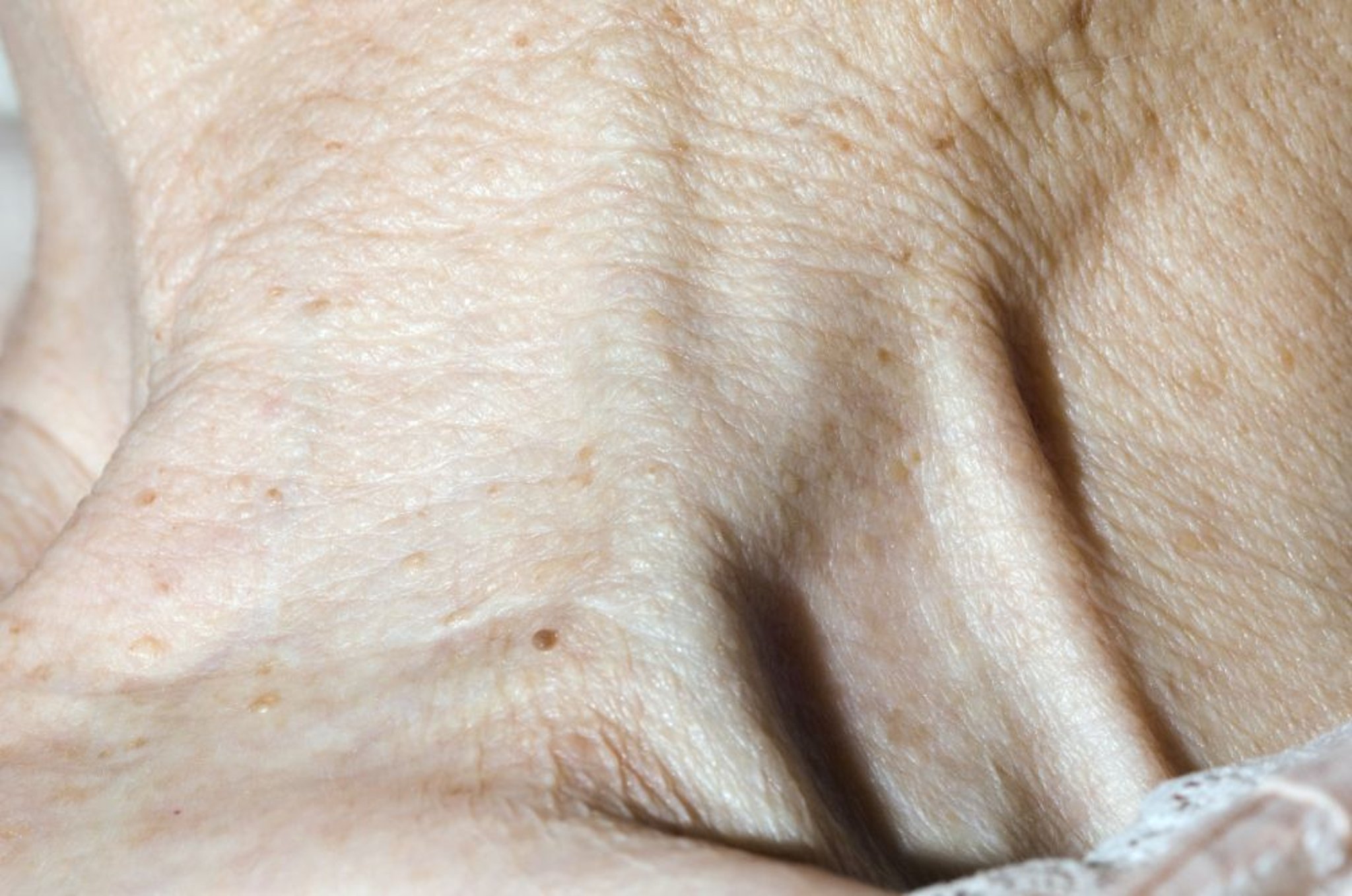 Distensione venosa giugulare