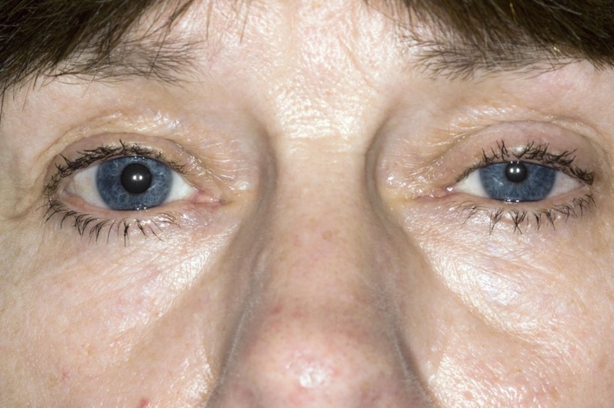 Синдром Горнера