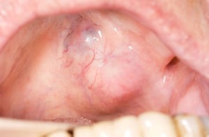 Adenoma pleomorfo della ghiandola salivare palatale