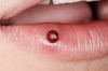 Pyogenic Granuloma (Lip)