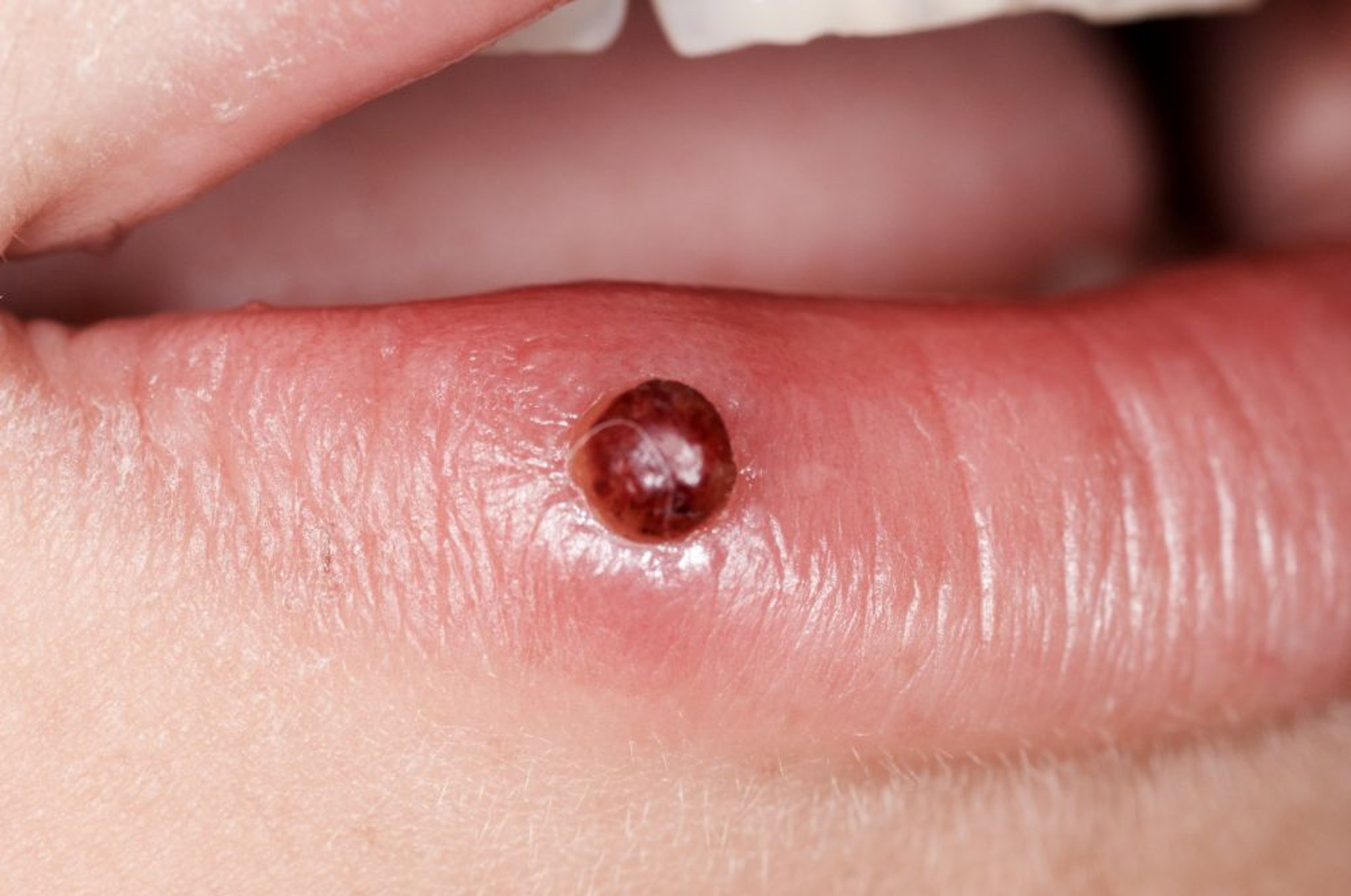 Granuloma piogenico (labbro)