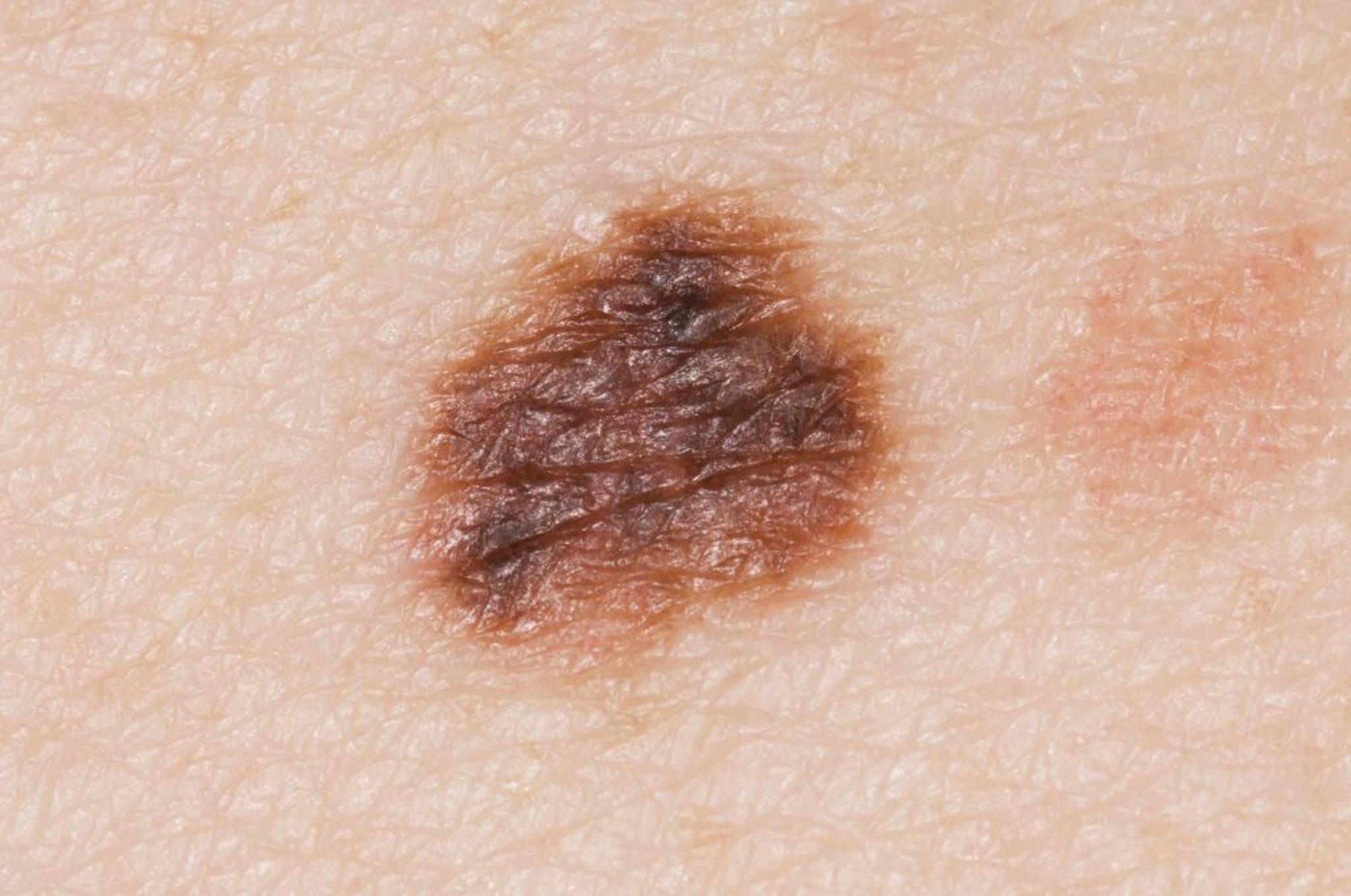 Atypische Leberflecken