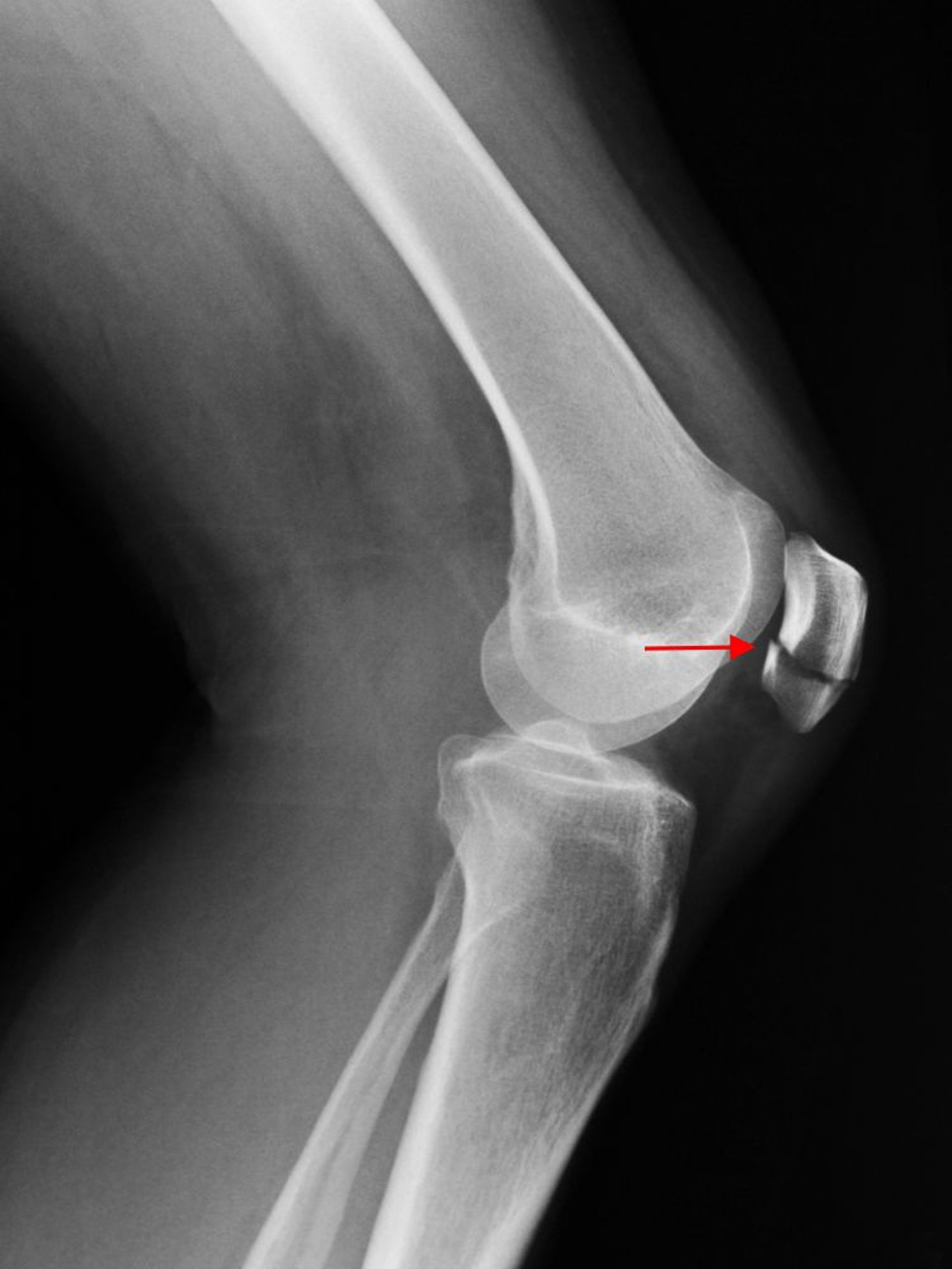 Patellar Fracture