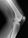 Fractures de la rotule