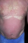 Erythrodermische Psoriasis