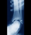 Ankle Sprain With Instability