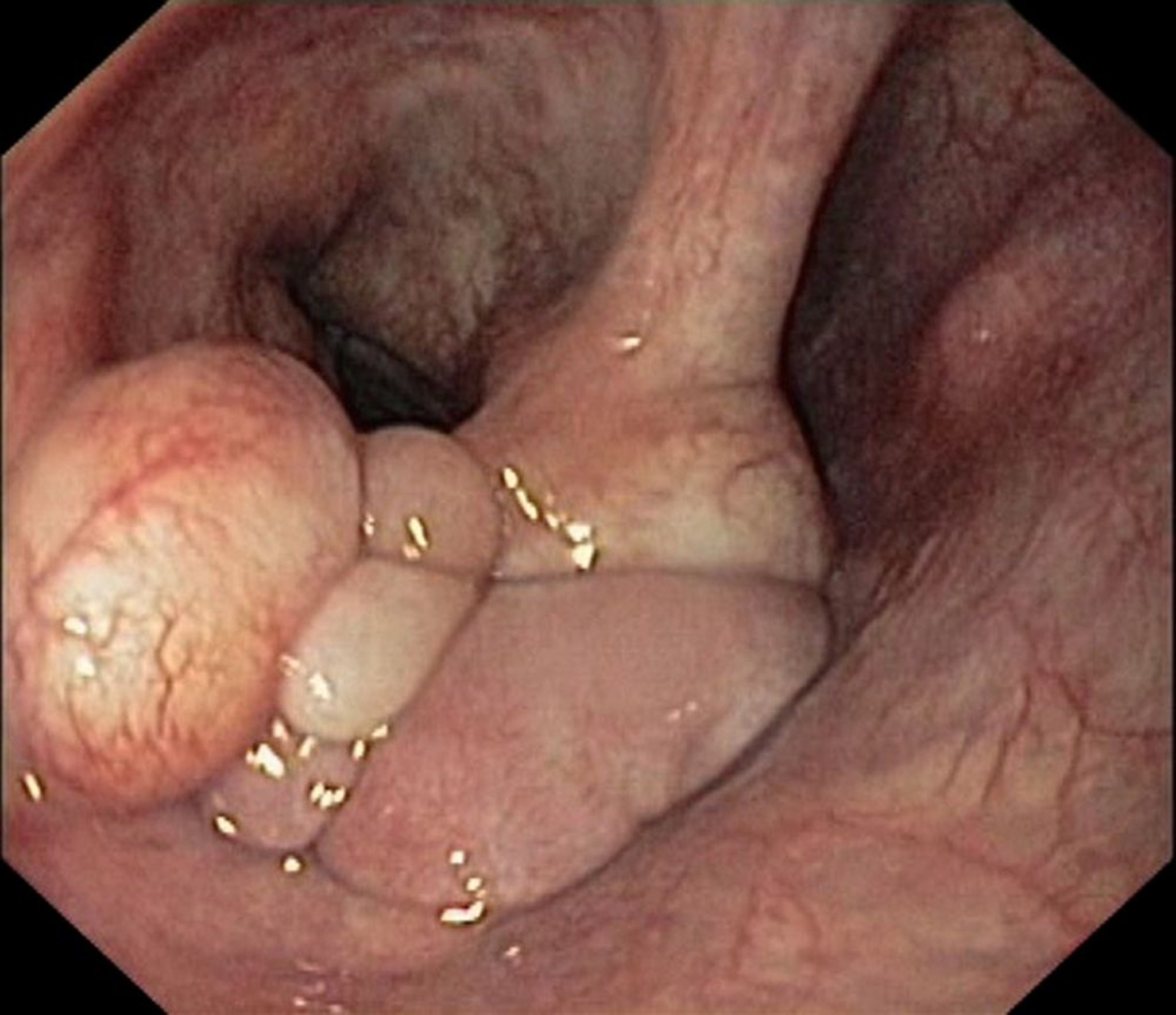 Tumor laríngeo benigno (fibrolipoma)