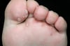 Enfermedad pie-mano-boca (lesiones del pie)
