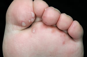 Maladie pieds-mains-bouche (lésions des pieds)