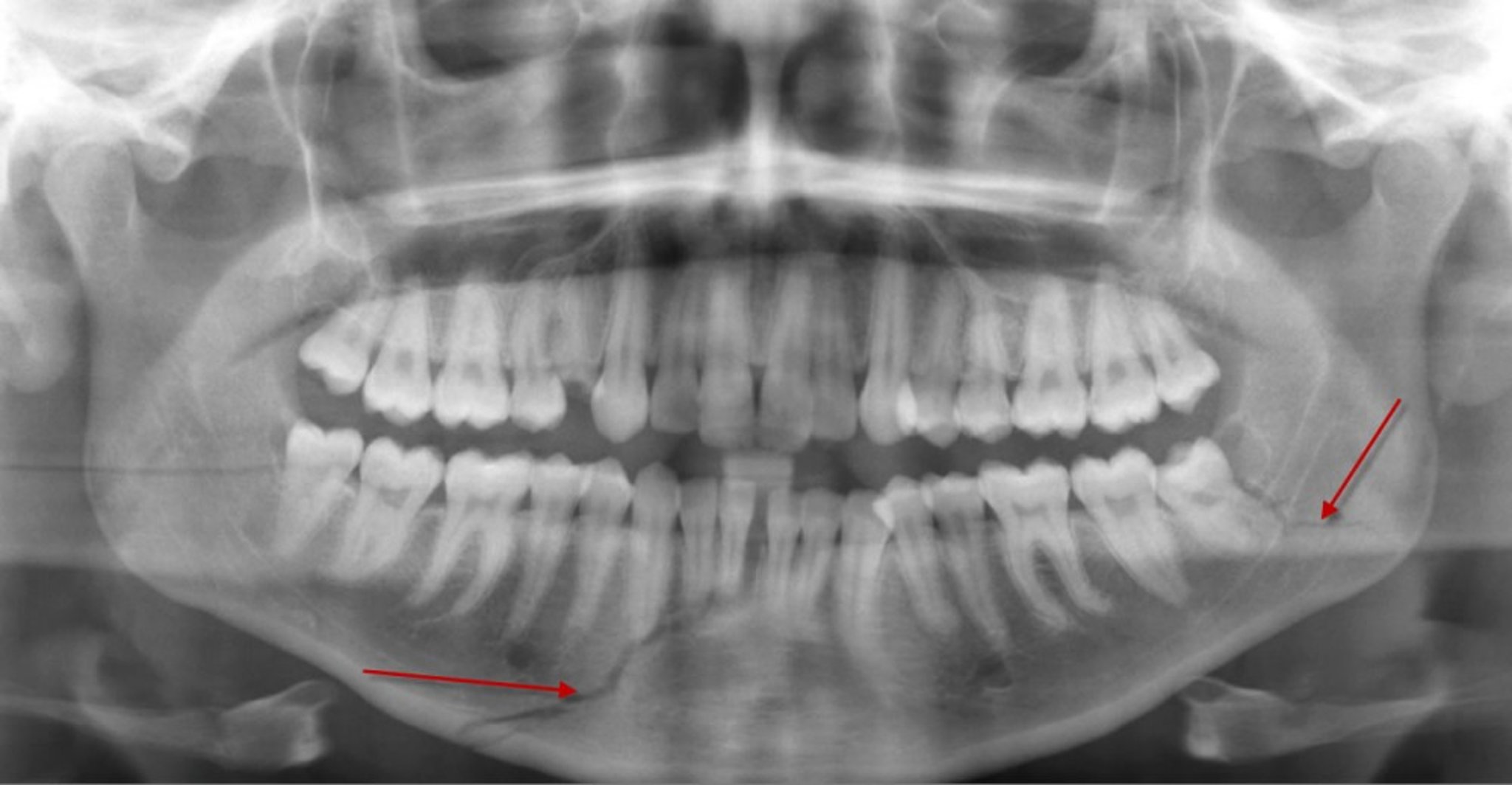 Fracture of Mandibular Body