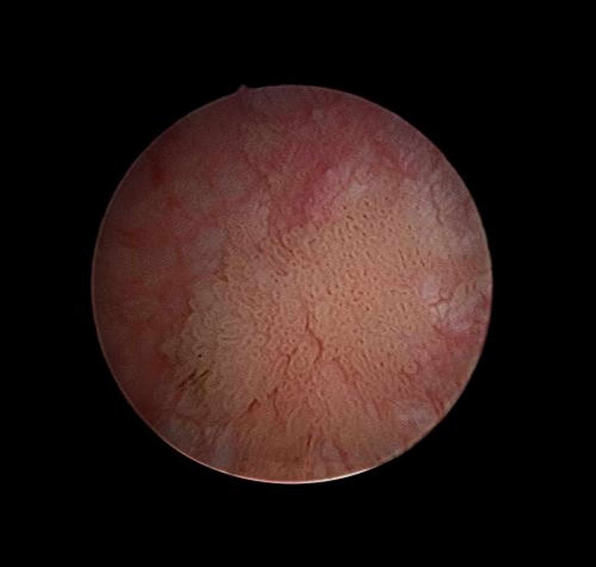 Cistoscopia (cancro della vescica)