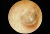 Normal Tympanic Membrane