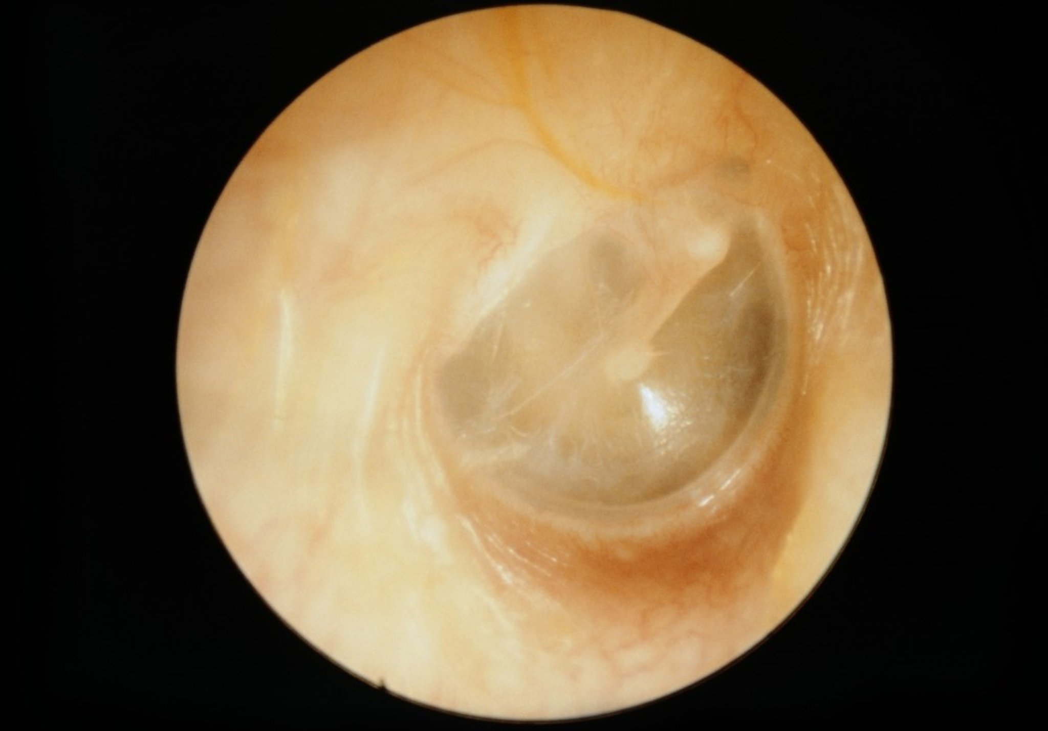 Normal Tympanic Membrane