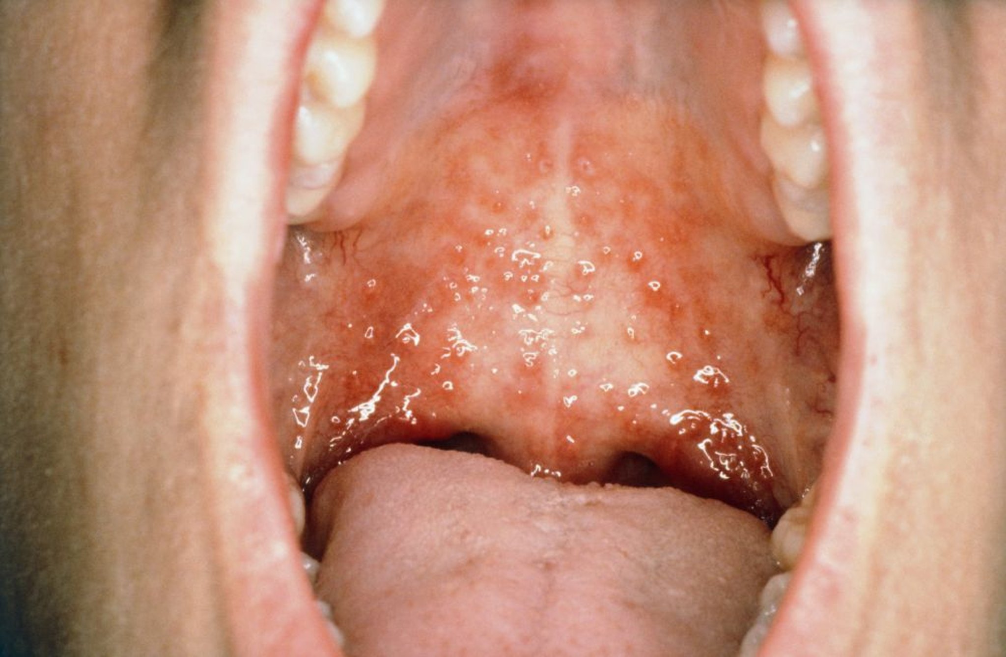 Viêm miệng Herpes