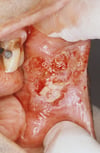 Carcinome malpighien de la cavité orale