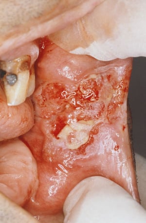 Carcinome malpighien de la cavité orale