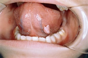 Плоскоклітинна папілома язика