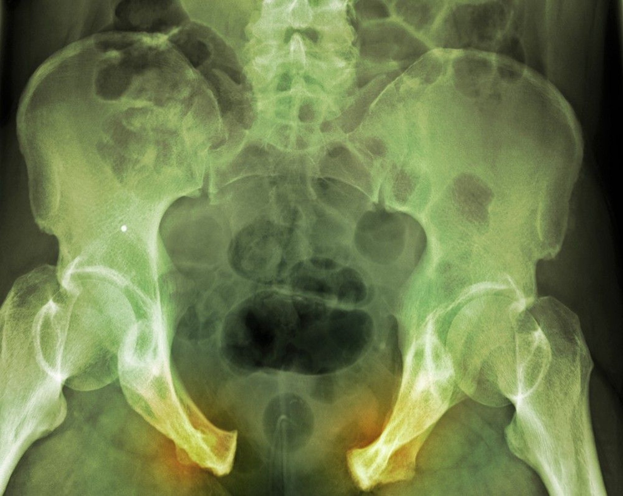 Pelvic Fracture