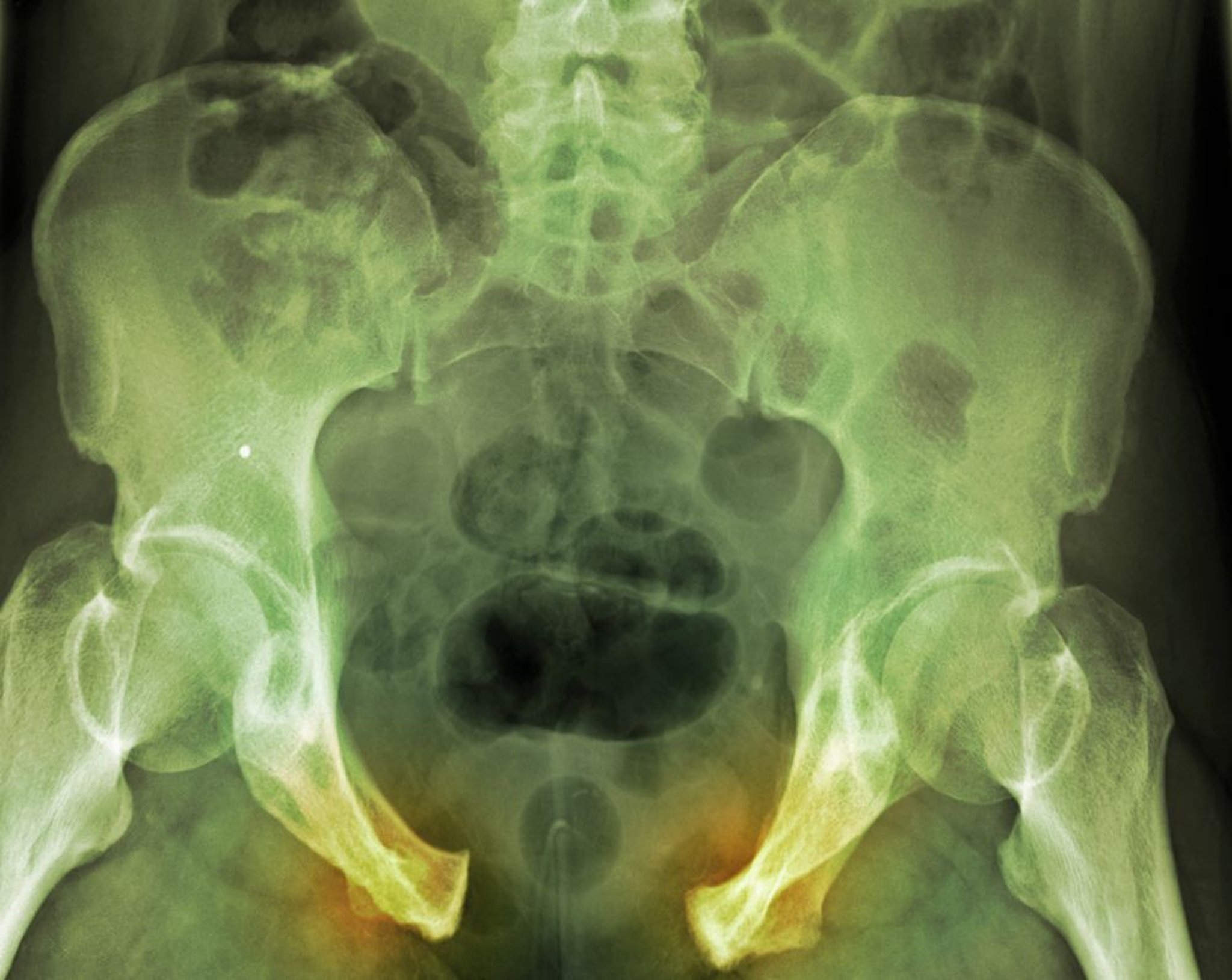 Fracture pelvienne