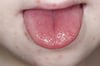 Enfermedad pie-mano-boca (lesiones bucales y faciales)