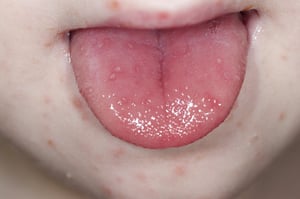 Malattia mano-piede-bocca (lesioni orali mano e faciali)
