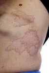 Granuloma anulare