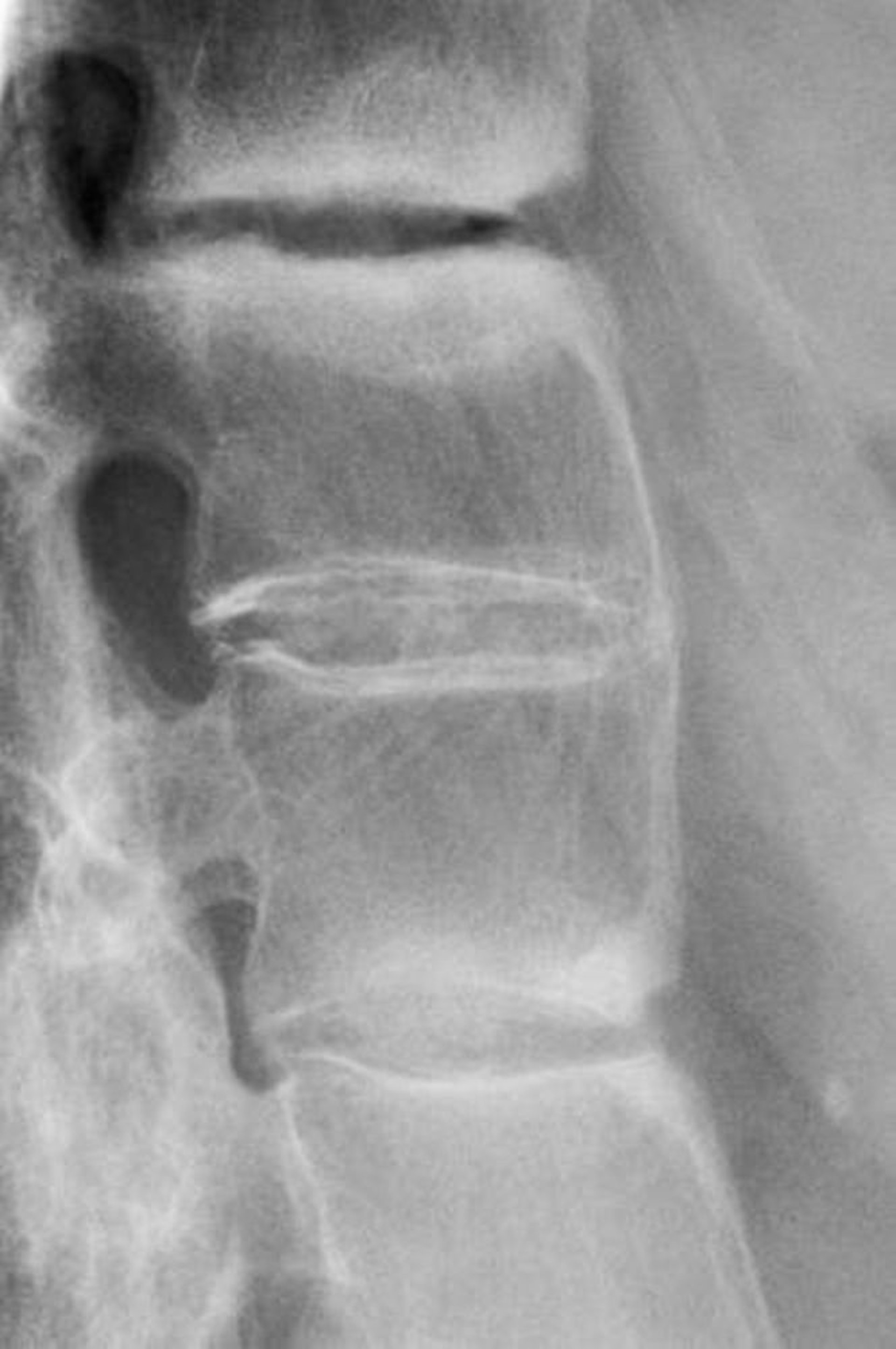 Espondilitis anquilosante