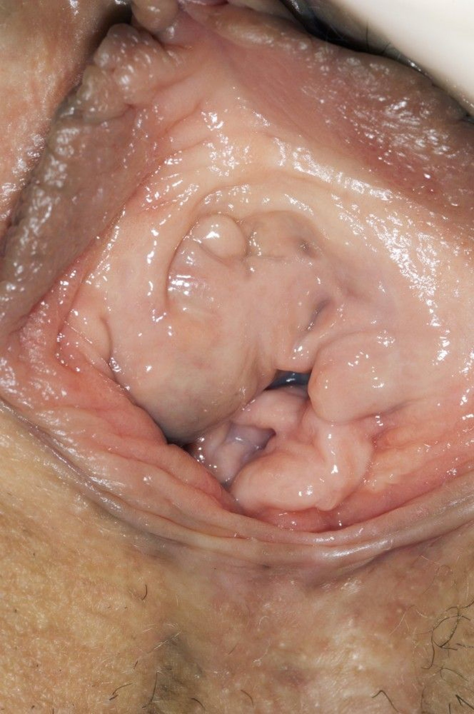 Skene Gland (Paraurethral) Cyst