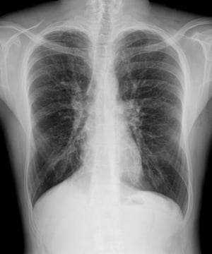 Fibrosis quística (radiografía)