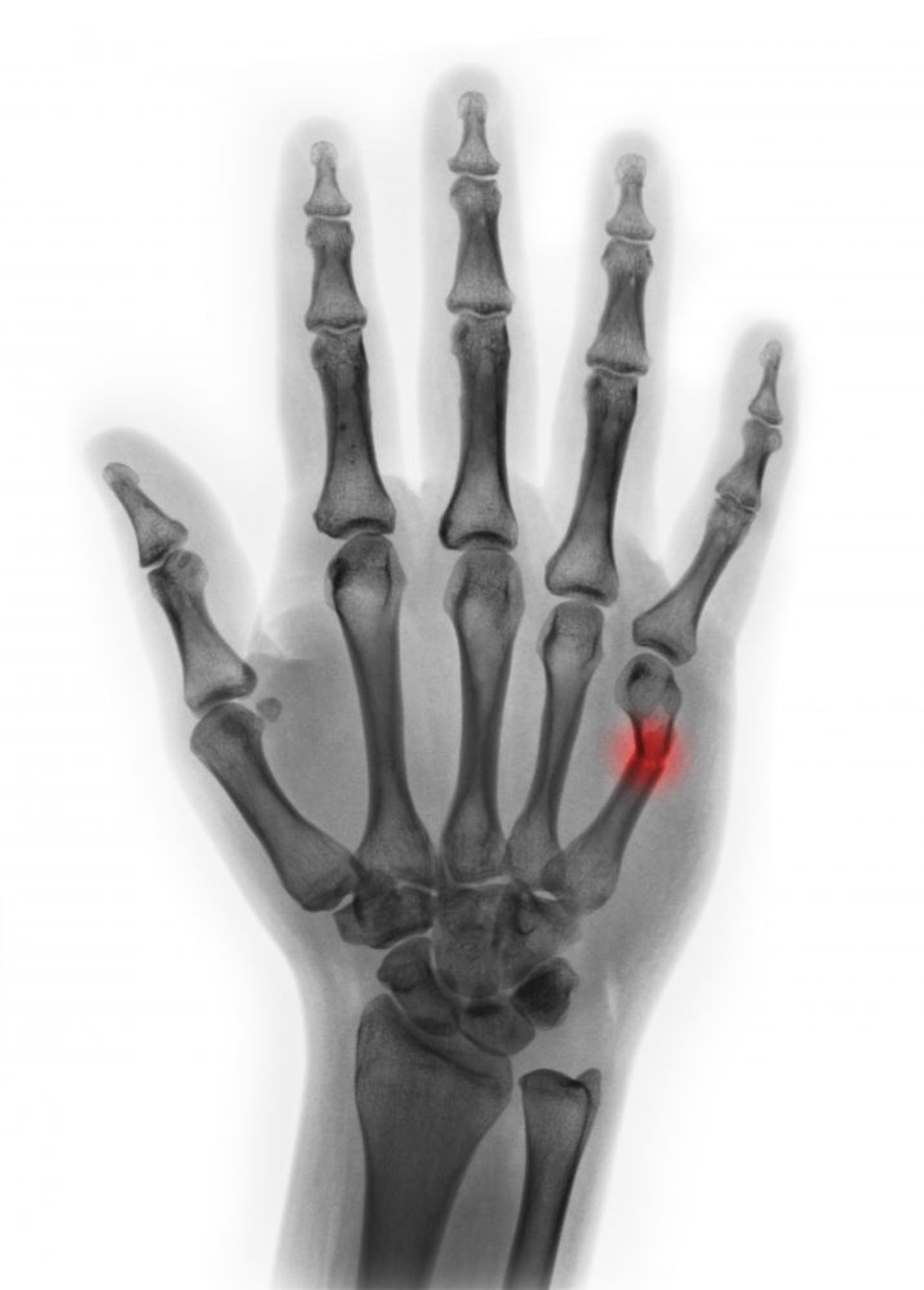 第5中手骨頸部骨折