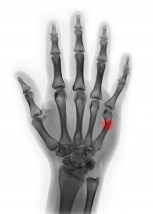 Fratura do colo do 5º metacarpal