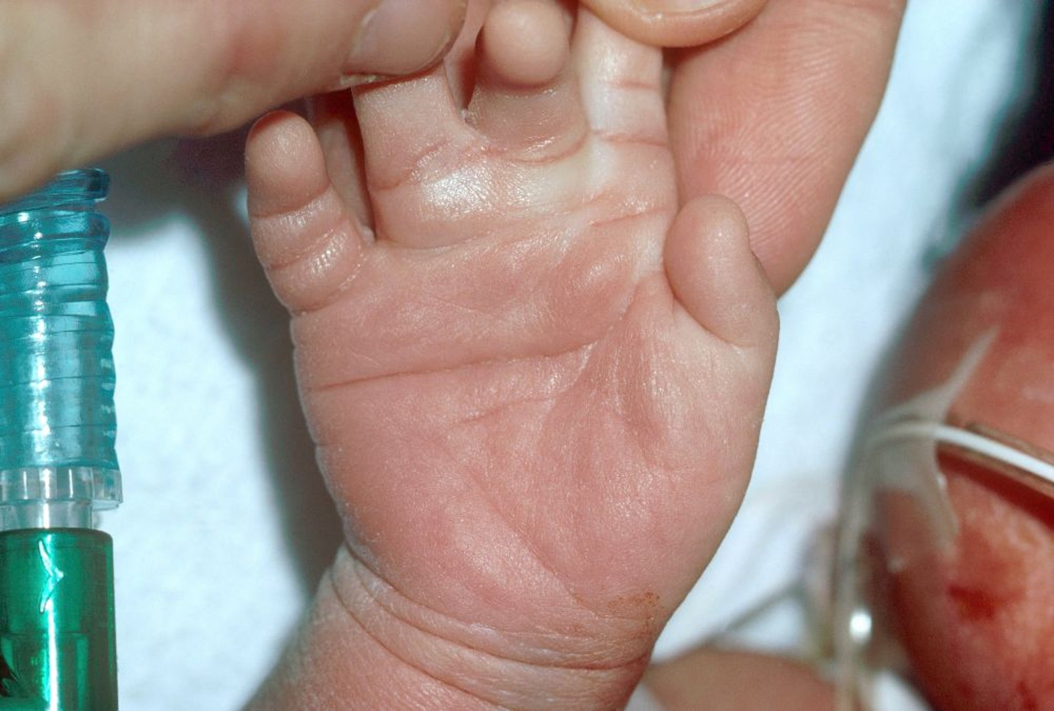 Vết nhăn Palmar ngang đơn