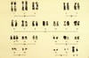Caryotype de trisomie 13 (syndrome de Patau, trisomie D)