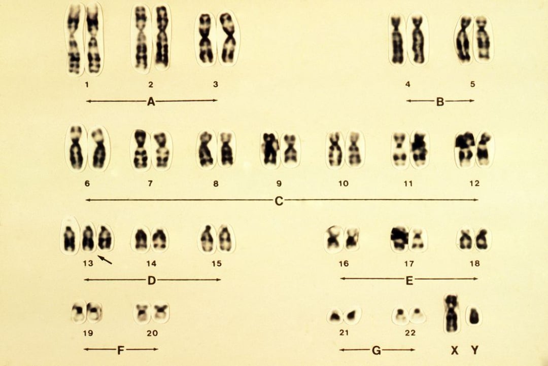 Imagecaryotype De Trisomie 13 Syndrome De Patau Trisomie D Édition Professionnelle Du Manuel Msd 