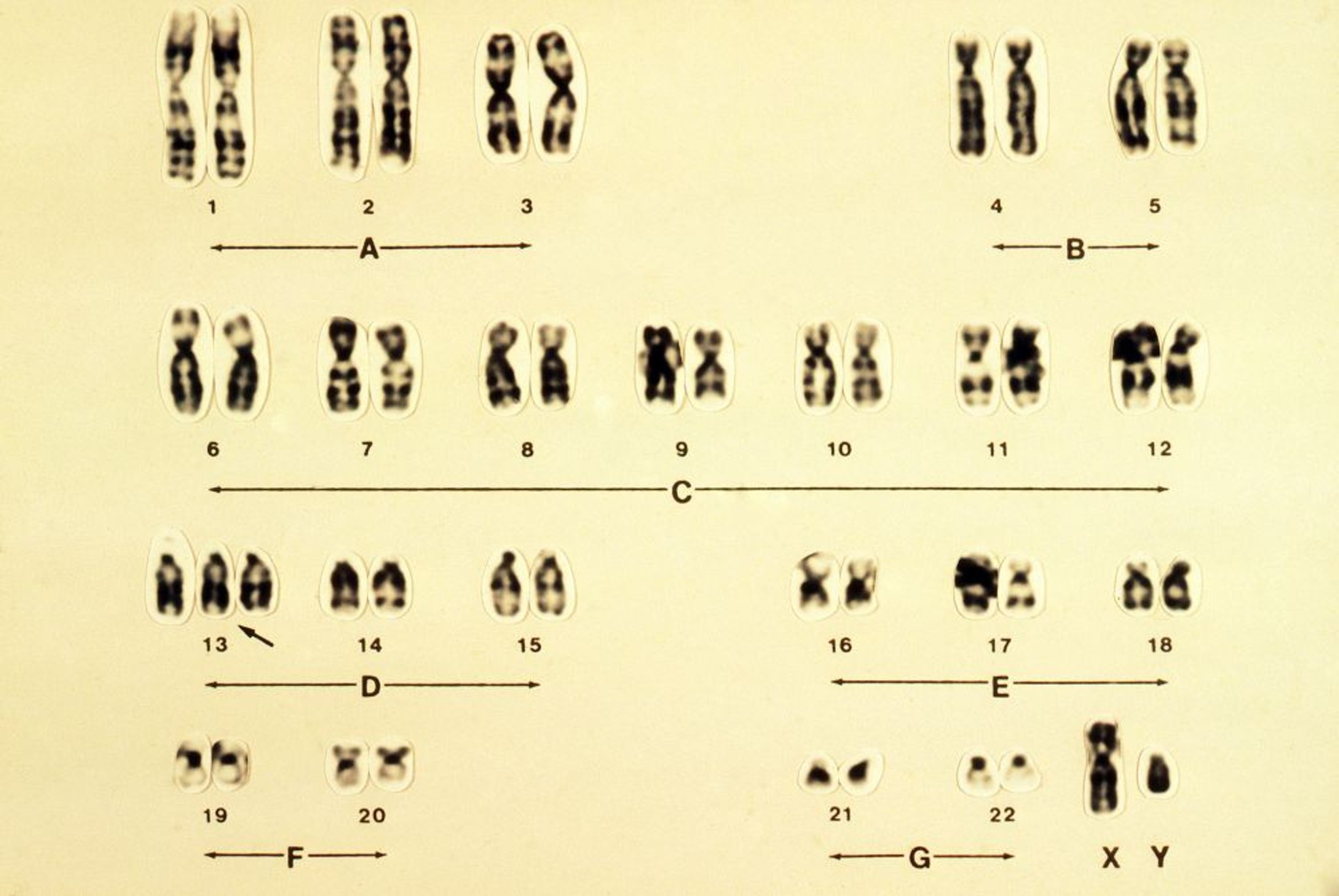 Caryotype de trisomie 13 (syndrome de Patau, trisomie D)