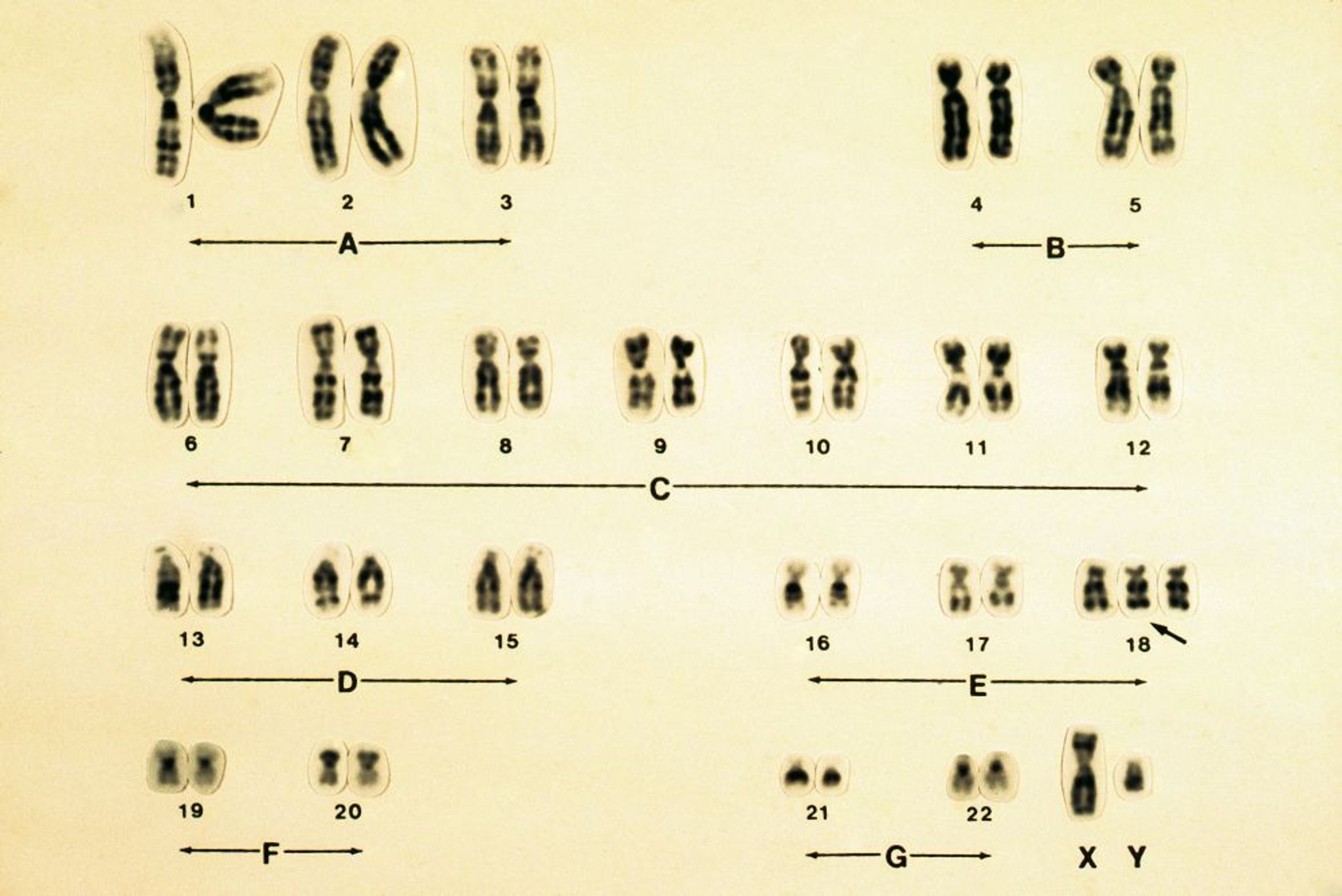 Trisomy 18 Karyotype