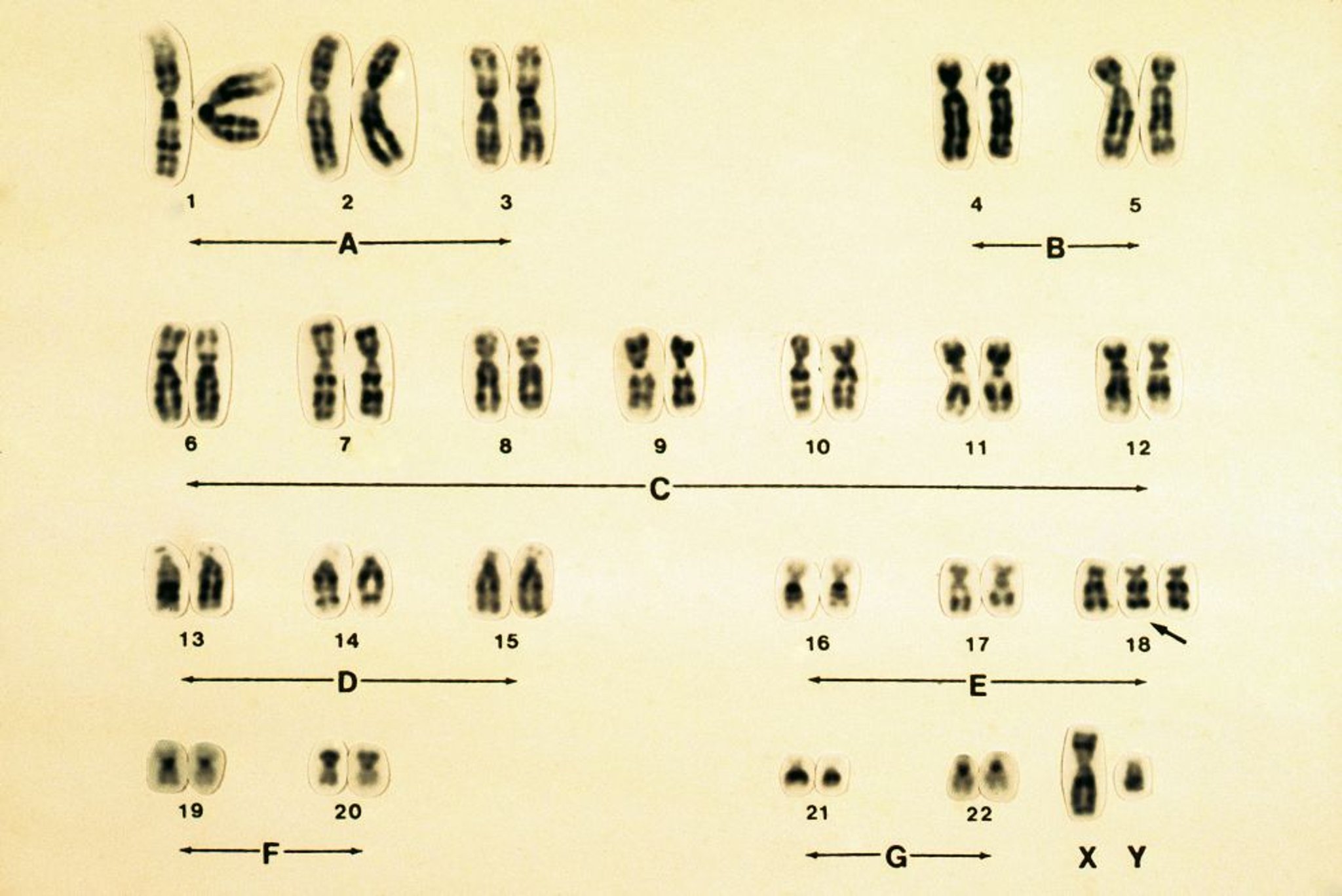 Cariotipo de la trisomía 18