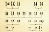 Caryotype de trisomie 18